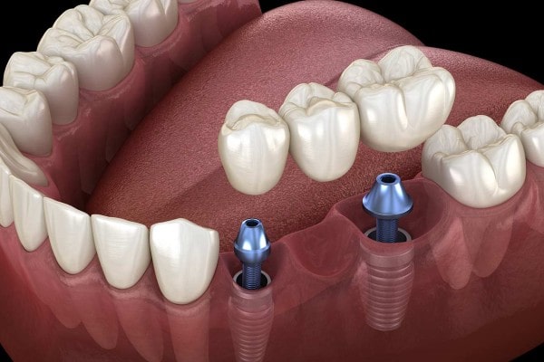 Everything You Need to Know About Dental Bridges