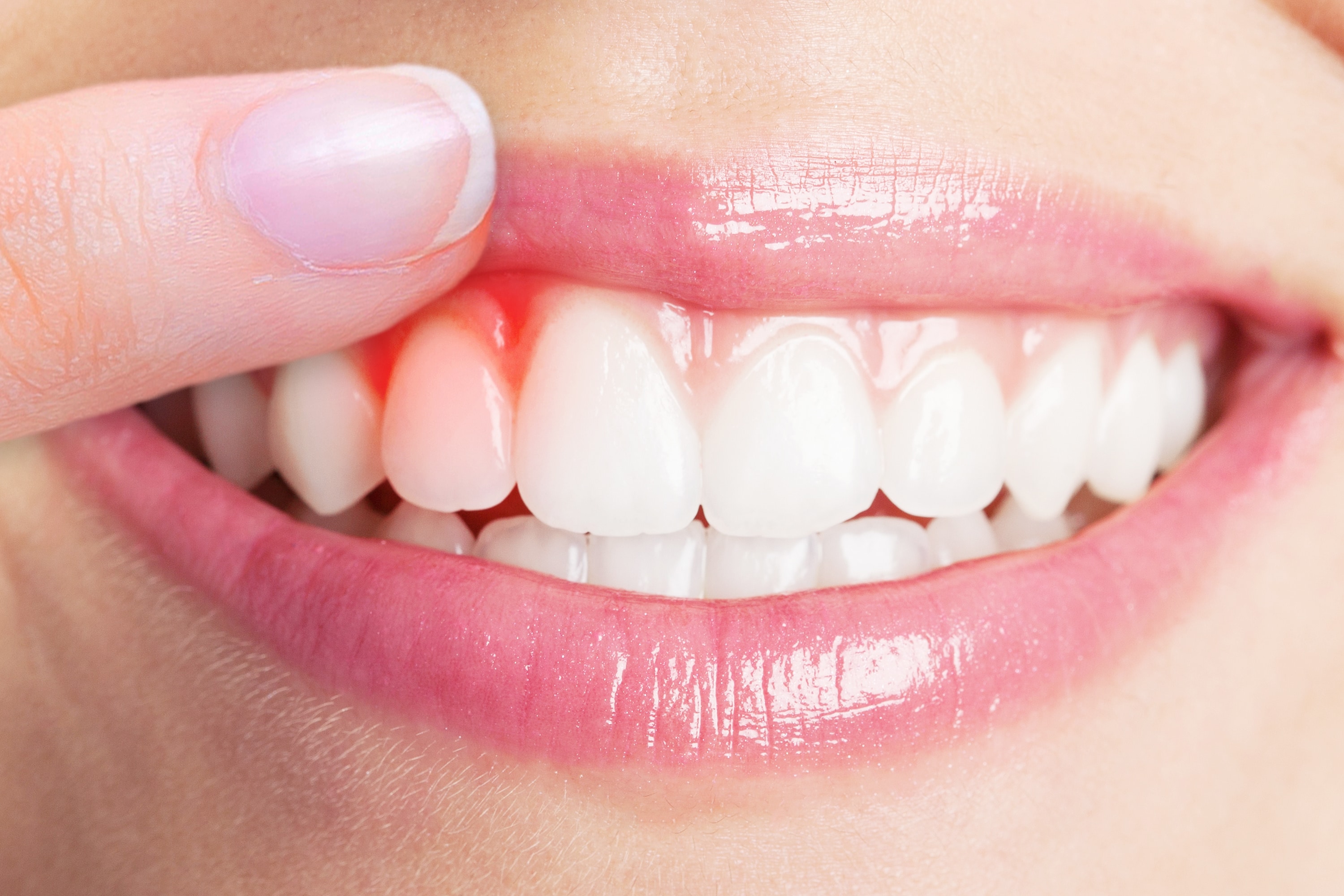 Best Dental Clinic for  Gum Treatment  in HSR Layout, Bangalore