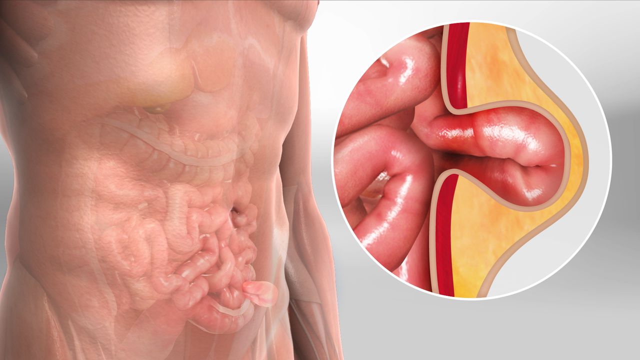 Best Laparoscopic Hernia Surgery in Sarjapur Road, Bangalore